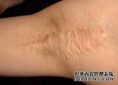 大连常见的腋臭的治疗方法